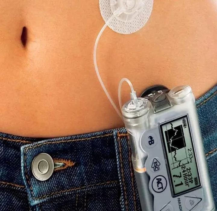 Jak skutecznie zdobyć fundusze na pompę insulinową?