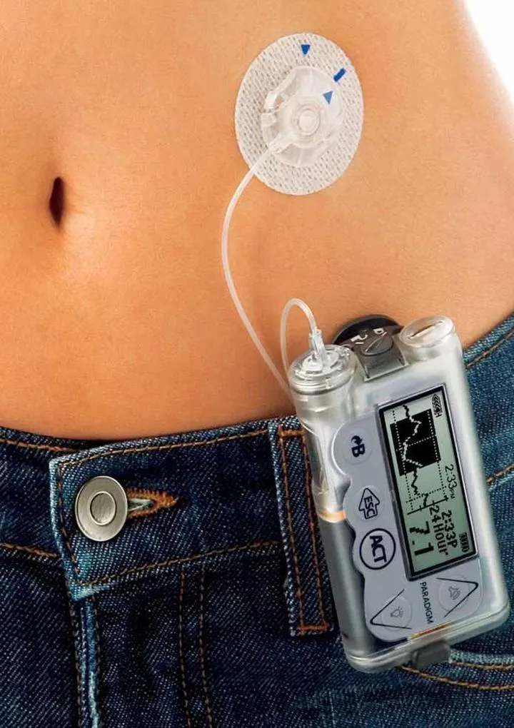 Dofinansowanie pompy insulinowej